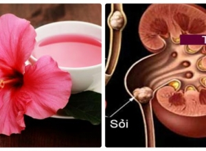 Mách nhỏ: Cách chữa sỏi thận bằng hoa râm bụt cực kỳ hiệu quả